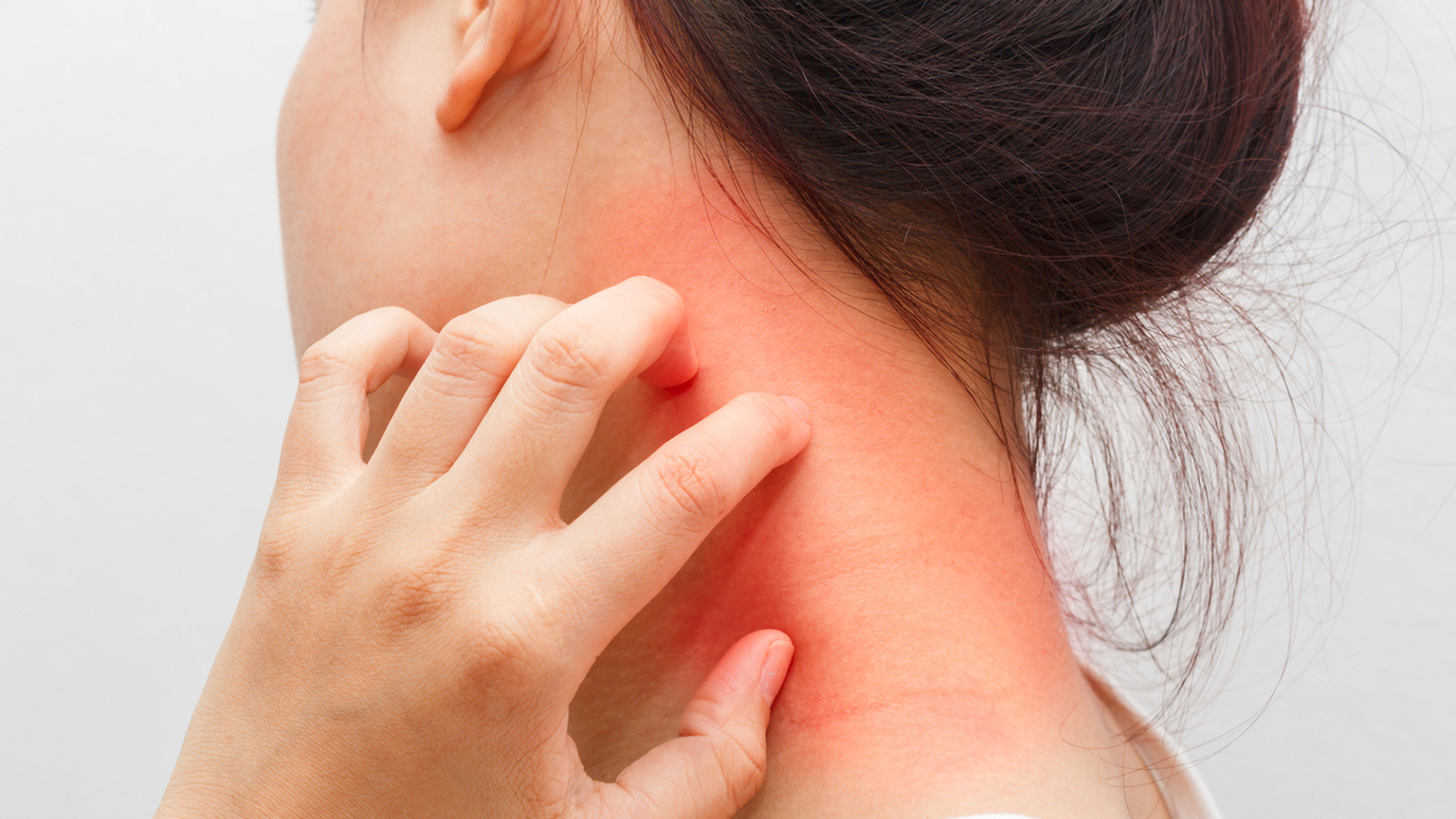 Atopik Dermatit İle Mücadelede Bilinmesi Gerekenler