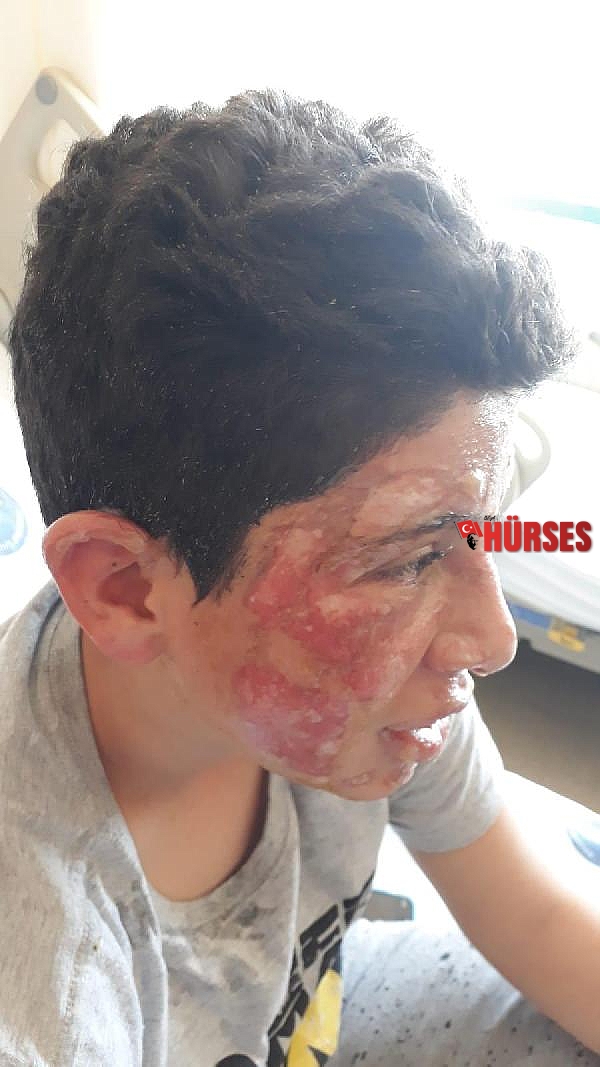 Yüzü yanan oğlu için hukuk mücadelesi başlattı