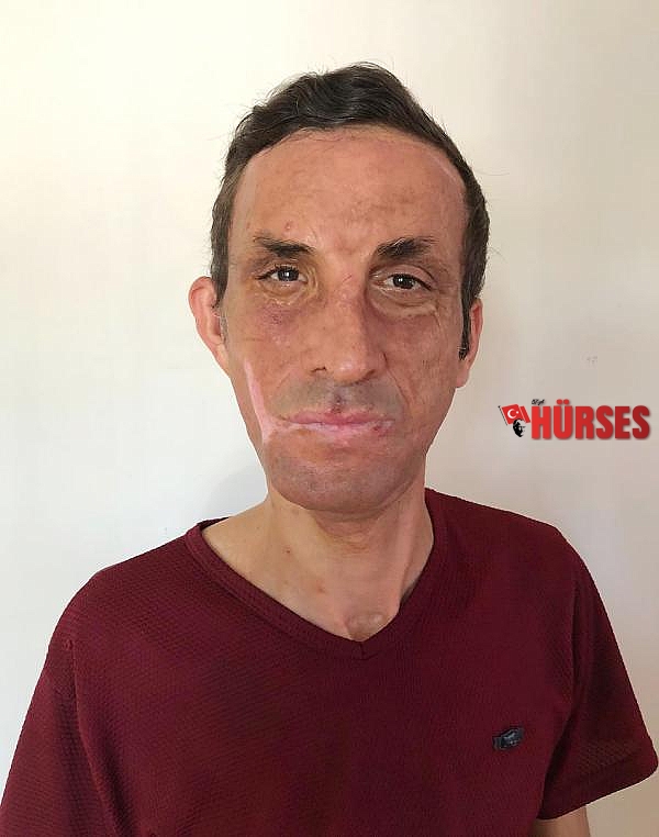 İlk yüz nakilli Uğur Acar: Koronavirüs nedeniyle 3 ay evden çıkmadım