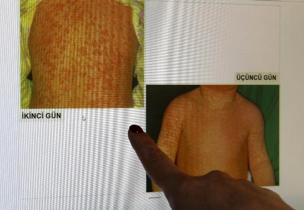 Doç. Dr. Kara'dan kızamıkta vaka artışına karşı aşı uyarısı