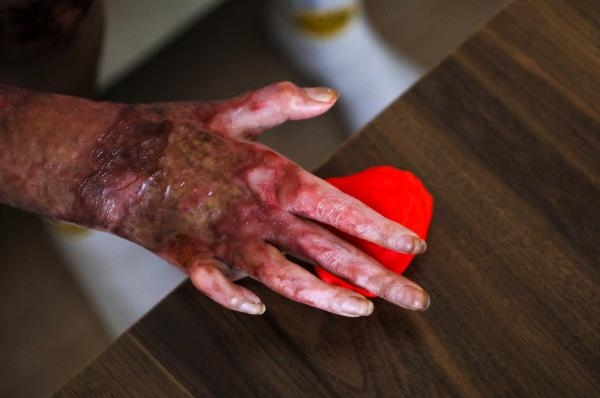 Benzin buharı parlayınca yüzü ve vücudu yanan Beyzanur, sanayideki işine dönmek istiyor