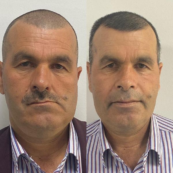 2 hastadaki sebebi bilinmeyen ağrı ve yüz bozulmasının nedeni 'tümör' çıktı