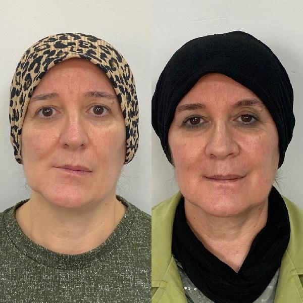 2 hastadaki sebebi bilinmeyen ağrı ve yüz bozulmasının nedeni 'tümör' çıktı