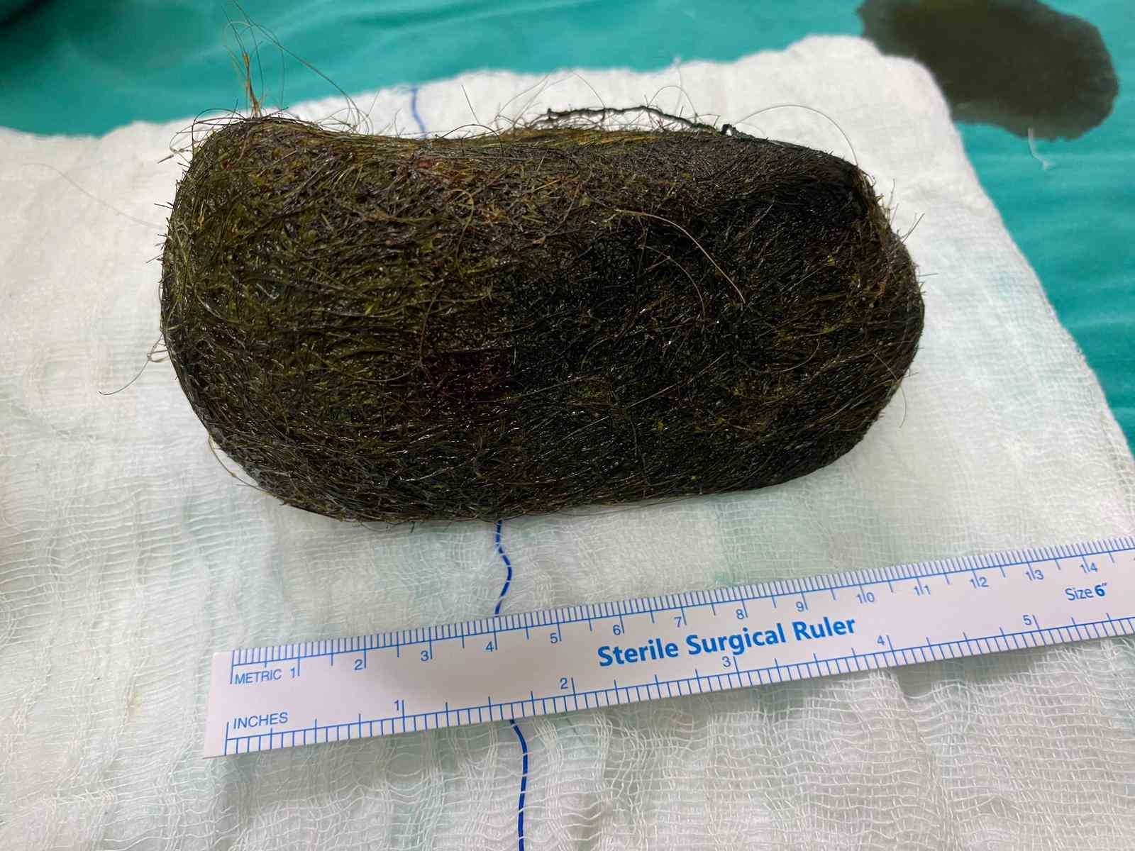 Karın ağrısı şikayetiyle hastaneye başvuran kadının midesinden 2 kilo saç çıktı