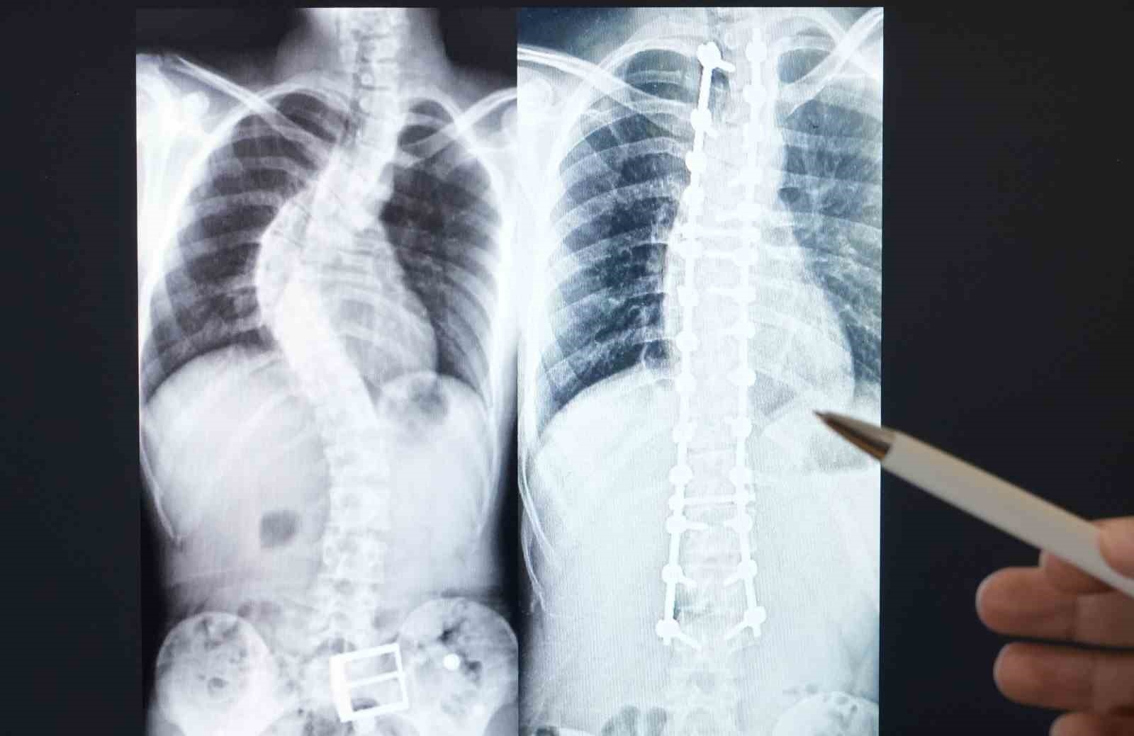 Skolyozun belirlenmesinde ailelere büyük görev düşüyor