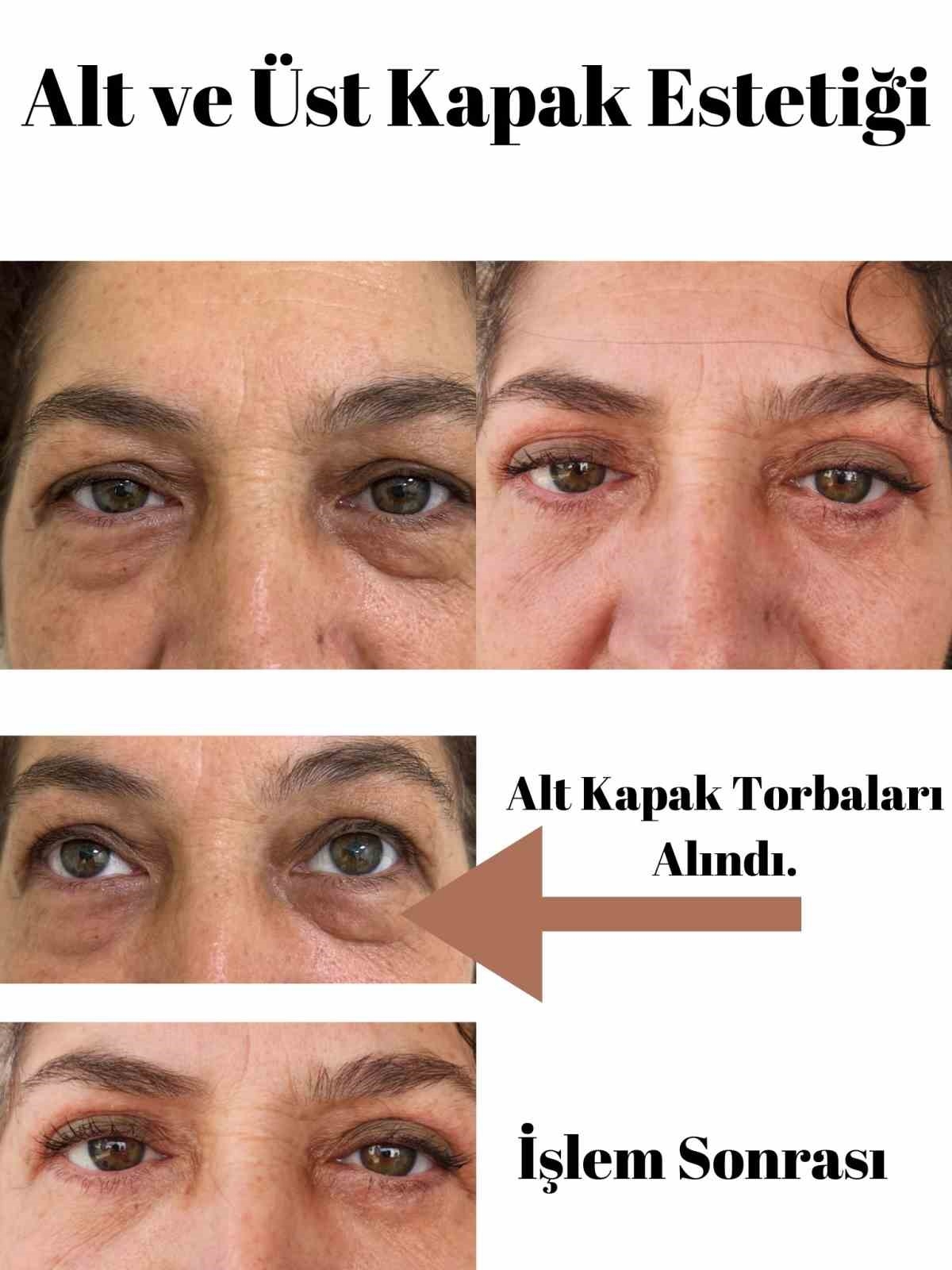 Elmalı Devlet Hastanesi'nde göz kapağı estetik ameliyatları başladı