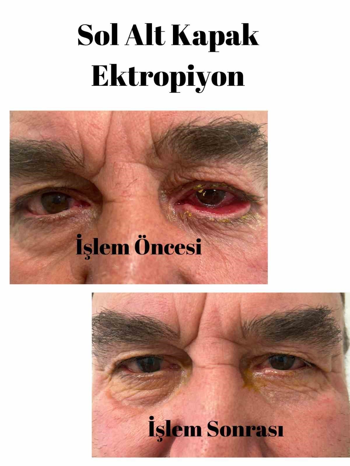 Elmalı Devlet Hastanesi'nde göz kapağı estetik ameliyatları başladı