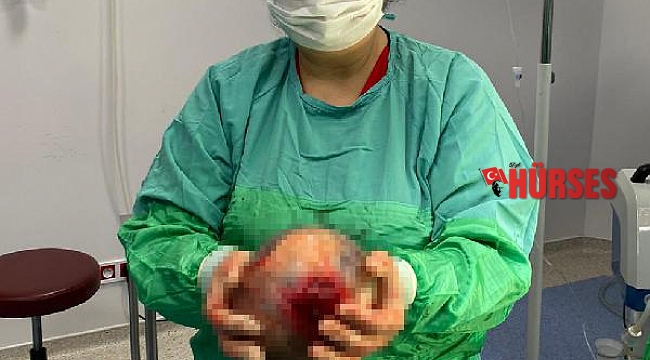 Rahminden 1,5 kiloluk kist çıktı