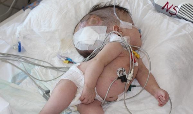 Hidrosefali hastası depremzede bebek, Antalya'da ameliyat edildi