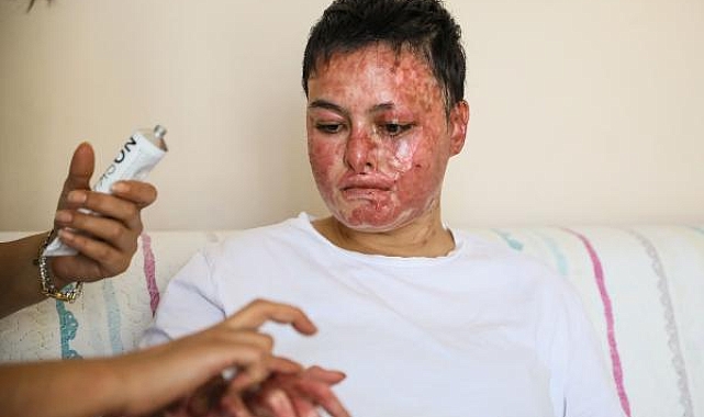 Benzin buharı parlayınca yüzü ve vücudu yanan Beyzanur, sanayideki işine dönmek istiyor