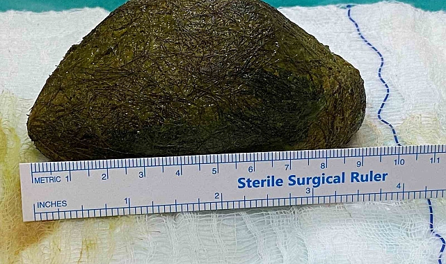 Karın ağrısı şikayetiyle hastaneye başvuran kadının midesinden 2 kilo saç çıktı