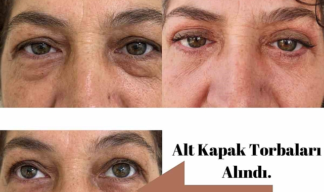 Elmalı Devlet Hastanesi'nde göz kapağı estetik ameliyatları başladı