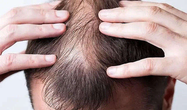 Saç Dökülmesinin Nedenleri ve Doğal Çözümler