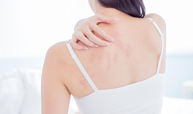Atopik Dermatit İle Mücadelede Bilinmesi Gerekenler