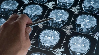 Alzheimer hastalığını erken evrede tespit edebilen kan testi geliştirildi