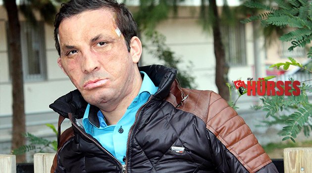 İLK YÜZ NAKİLLİ ACAR, GRİPTEN HASTANEDE