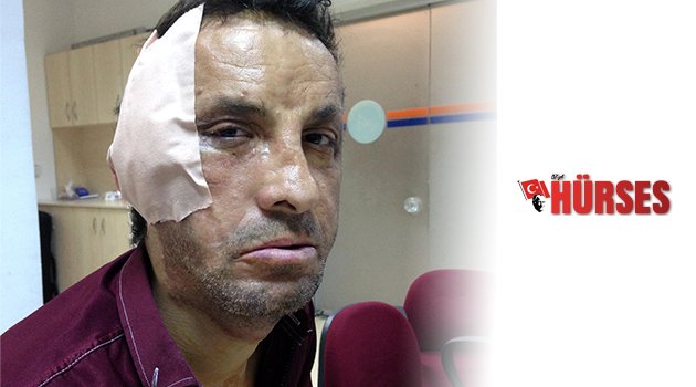 İLK YÜZ NAKİLLİ UĞUR ACAR'A, ESTETİK MÜDAHALE