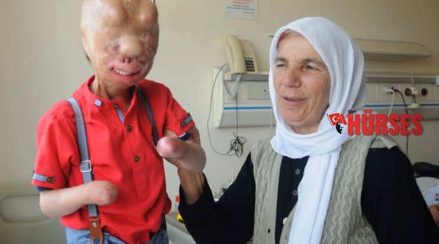 YANIK TEDAVİSİ GÖREN SERKAN VE FİRDEVS'E YARDIM YAĞIYOR