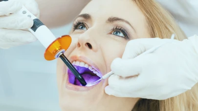 Gülüş Tasarımı! Kompozit Laminalar