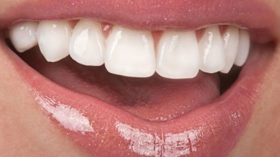 Lamina Sonrası Bakım: Estetik Gülüşün Kalıcılığı İçin Bilinmesi Gerekenler