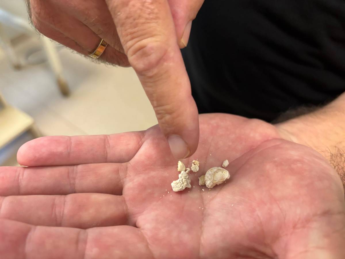 Tükürük bezinden, en büyüğü 2 santim olan 5 taş çıkarıldı